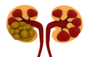 Things you need to know about acute renal colic