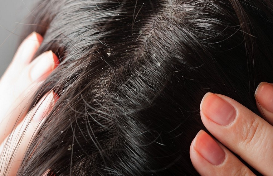 Medical Shampoos for Dandruff: